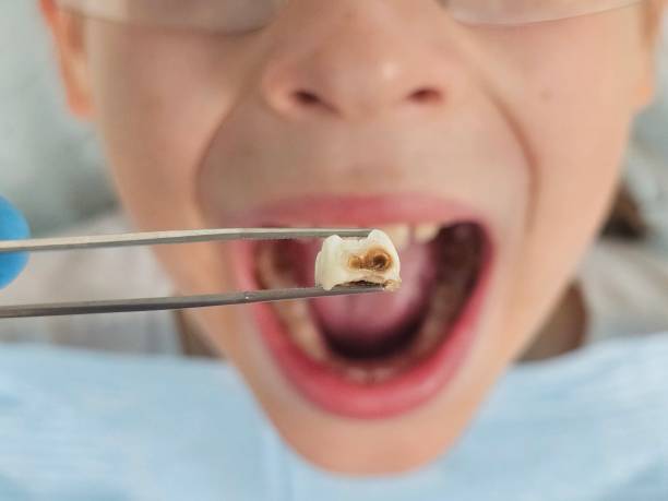 Best Emergency Treatment for Toothache in Panama, OK